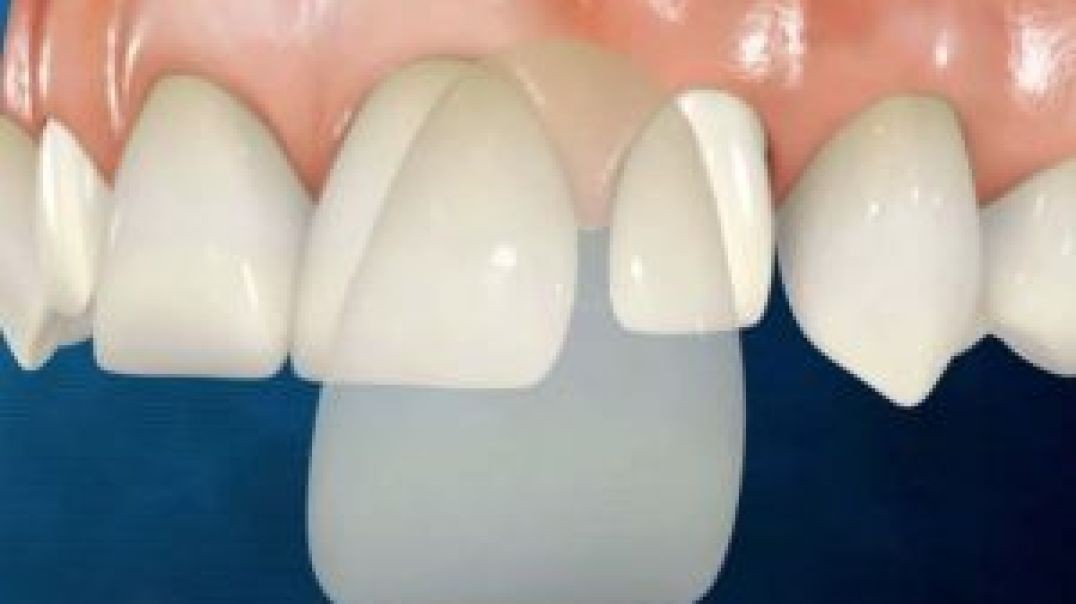 Smile Plus : Dental Veneers in Homestead, FL