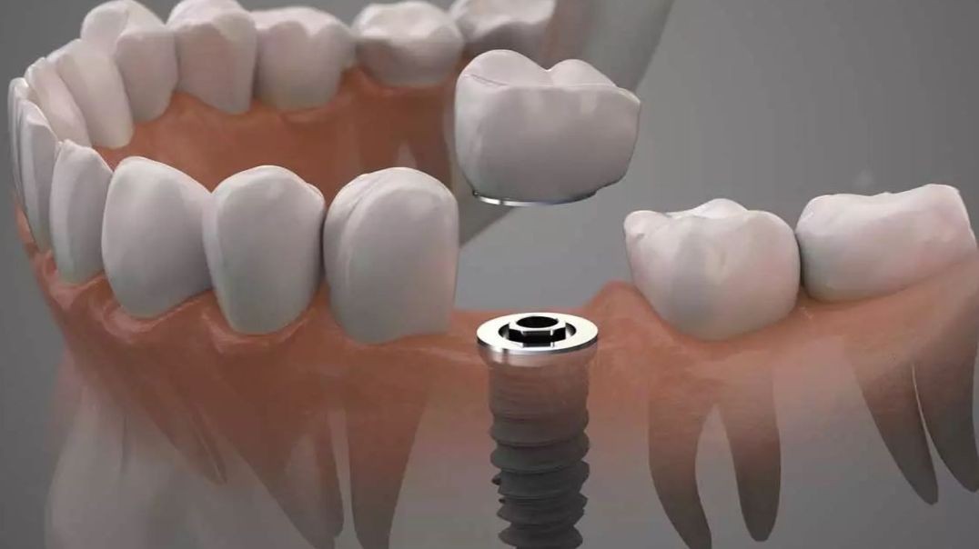 ⁣DB Dental Care : Dental Implant in Miami, FL : 33165